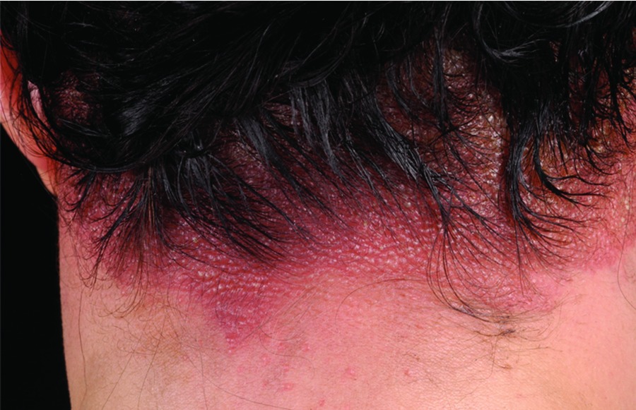 Allergic Reactions to Hair Dye